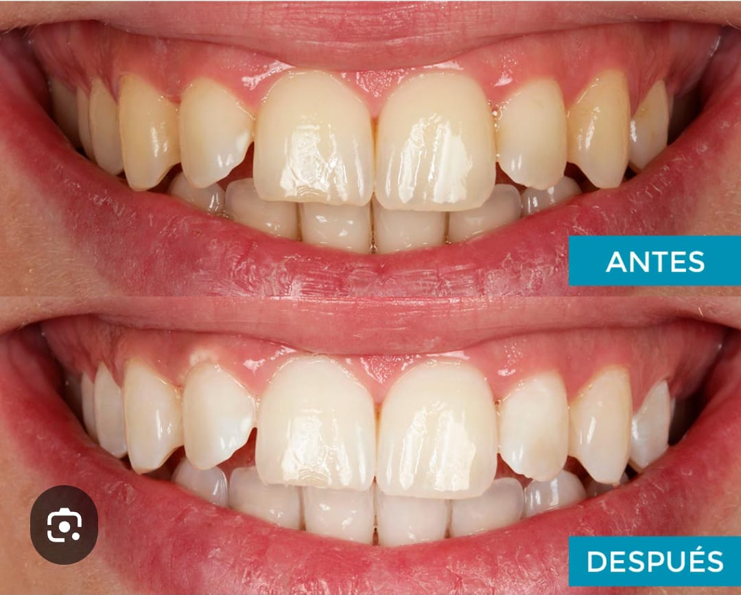 Blanqueamiento dental